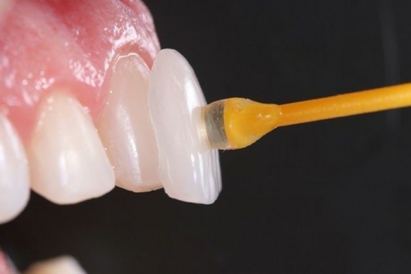 Onde Encontro Lente de Contato para Os Dentes Jardim Novo Horizonte - Lente de Contato Dental