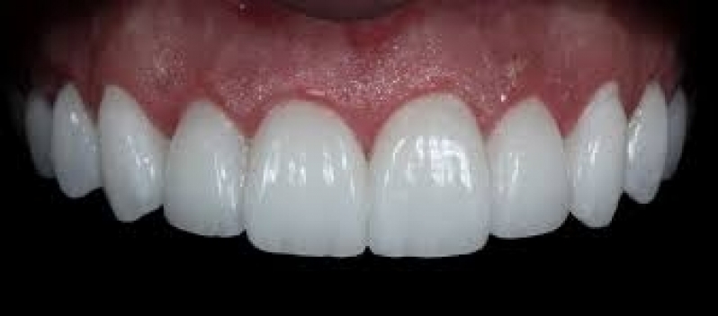 Onde Encontro Lente Dental de Porcelana Jardim Bom Refúgio - Lente de Contato para Dentes Tortos