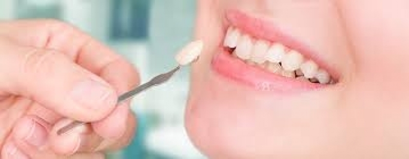 Onde Encontro Lente para Dentes Embu Guaçu - Lentes de Contato Dental