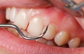 Periodontia na Chácara Pirajussara - Periodontia