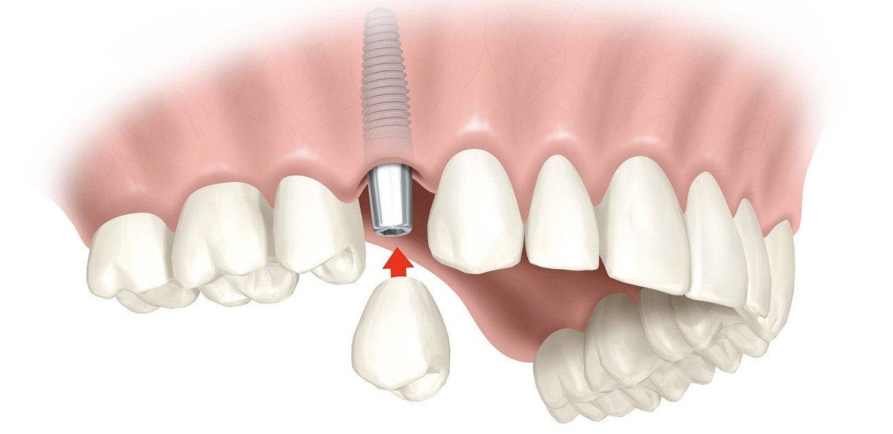 Preço Médio de Implante Dentário Embu Guaçu - Implantes Dentários em Sp
