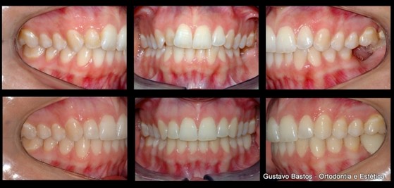 Quanto Custa Aparelho Dentário Invisível Jardim São Roque