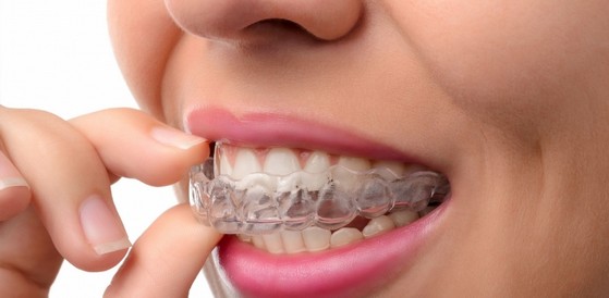 Quanto Custa Aparelho Ortodôntico Invisalign Jardim Helga - Invisalign Dentista