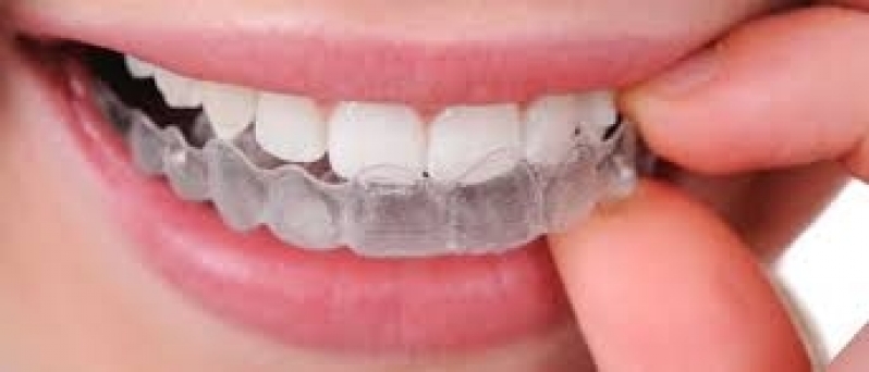 Quanto Custa Aparelho Transparente de Resina Jardim São Januário - Aparelho Transparente Dental