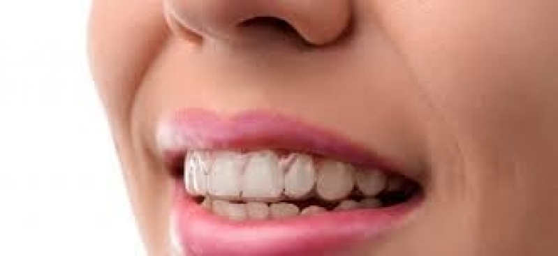 Quanto Custa Aparelho Transparente Invisalign Embu-Mirim - Aparelho Dentário Invisível