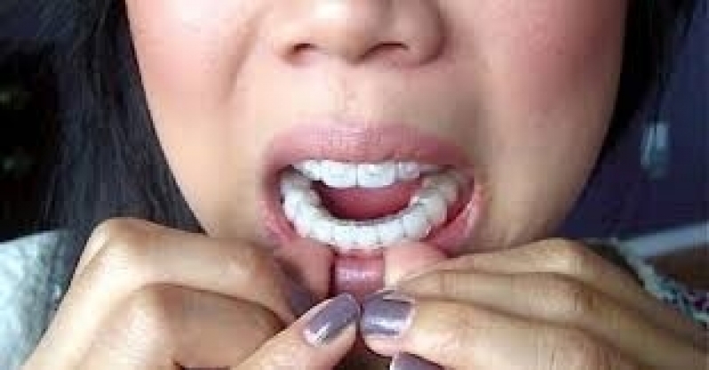 Quanto Custa Invisalign Aparelho Ortodôntico Jardim Jamaica - Aparelho Autoligado Invisalign