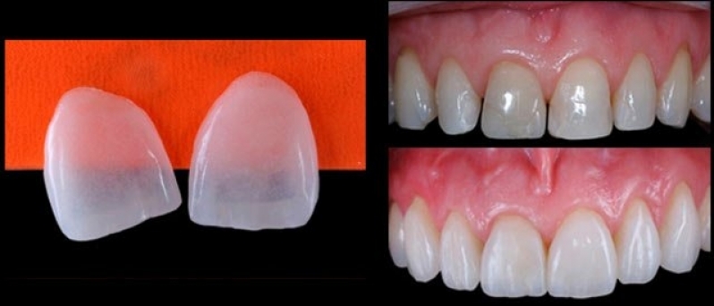 Quanto Custa Lente de Contato para Os Dentes Conjunto Residencial Morumbi - Clínica para Lentes de Contato Dental