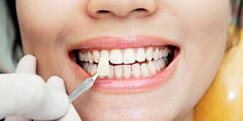 Quanto Custa Lente para Dentes Capelinha - Lente de Contato para Os Dentes