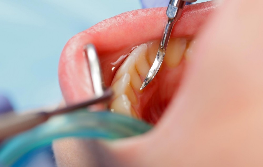 Raspagem Periodontal Quanto Custa no Jardim Novo Oriente - Dentista Especialista em Periodontia