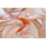 aparelho dentário com borrachinha no Jardim Catanduva