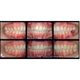 aparelho invisalign transparente