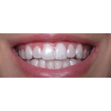 aparelho ortodôntico invisalign