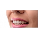 Aparelho Transparente Invisalign