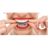 aparelho transparente invisalign Jardim Eti