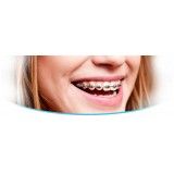 aparelhos dentários estéticos em Previdência