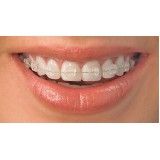 aparelhos dentários no Jardim São Gilberto