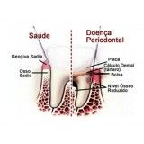 cirurgia periodontal quanto custa no Jardim Elisabeth