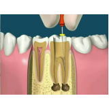clínica com tratamento dentário e resina na Vila Indiana