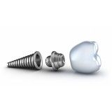 clínica de implante dentário preço na Vila Alteza