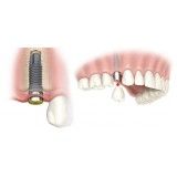 clínica de implantes de dentes Jardim Maria Rosa