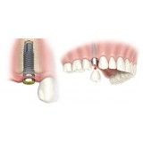 clínica de implantes de dentes em Caxingui