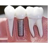 clínica de implantes dentários em sp no Jardim Bonfiglioli