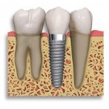 clínica odontológica de implante dentário no Jardim Itamarati