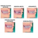 colocação de aparelho dentário com borrachinha no Capelinha