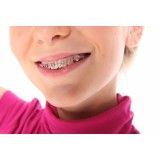colocação de aparelho dentário fixo na Chácara do Bom Conselho
