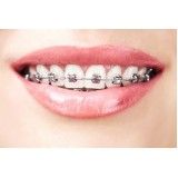 colocação de aparelhos dentários modernos no Jardim Novo Oriente