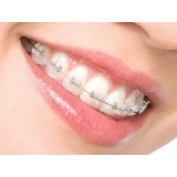 colocação de aparelhos dentarios móvel no Jardim São Januário