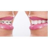colocação de aparelhos dentarios novos na Vila Franca