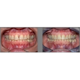 colocar aparelho invisalign Jardim Peri Peri