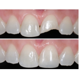 dentista especialista em prótese dentaria no Jardim Novo Horizonte