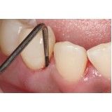 diagnóstico clinico em periodontia no Campo Limpo