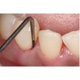 diagnóstico clinico em periodontia na Vila Analia