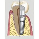implante de dentário custo no Capelinha