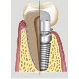 implante de dentário custo no Jardim Rosana