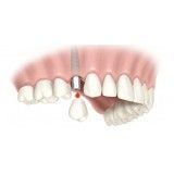 clínica de implante dentário