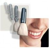 Implantes Dentários em Sp