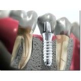 implante dentário valor de cada dente na Vila Analia