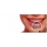 implantes de dentes na Vila Olga