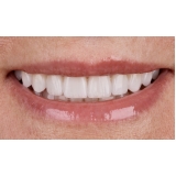 lente de contato dental Jardim Nadir