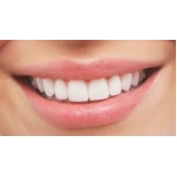 lente para dentes Jardim Peri Peri