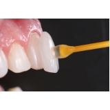 lente de contato para os dentes