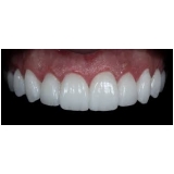 lente dental de porcelana