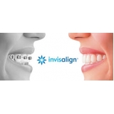 onde encontro aparelho autoligado invisalign Vila Franca