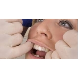 onde encontro aparelho ortodôntico invisalign Chácara do Bom Conselho