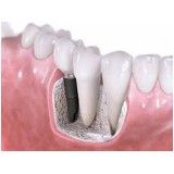 preço de implante dentário na Vila Gomes