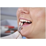 quanto custa lente dental Jardim Samara